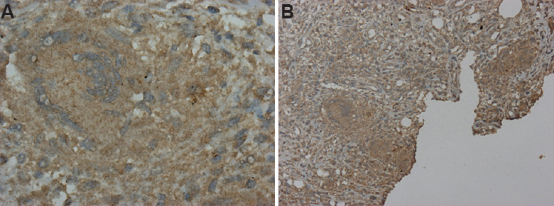 (A) Photomicrograph of skin biopsy (×10); positive for CD1a. (B) Photomicrograph of skin biopsy showing epithelioid cell granuloma positive for CD1a (×40).